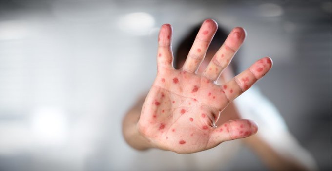 Se triplican casos de sarampión en el mundo